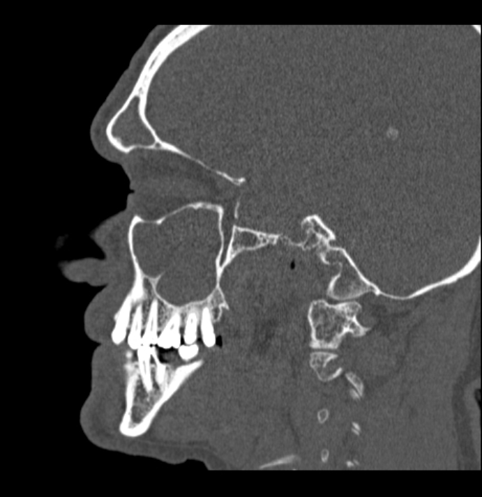 Antrochoanal polyp (Radiopaedia 79011-92169 Sagittal bone window 51).jpg