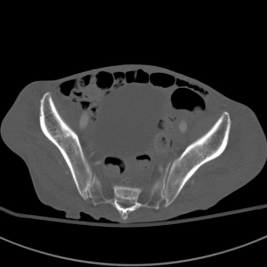 Aortic aneurysm with spinal destruction (Radiopaedia 42301-45410 Axial bone window 90).jpg