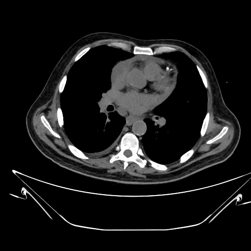 File:Aortic arch aneurysm (Radiopaedia 84109-99365 Axial non-contrast 147).jpg