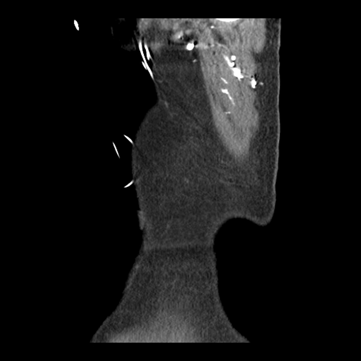 Aortic arch graft infection (FDG PET-CT) (Radiopaedia 71975-82437 C 67).jpg