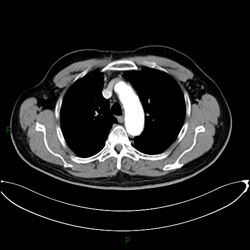 Aortic arch origin of left vertebral artery (Radiopaedia 46327-50737 Axial post contrast 35).jpg