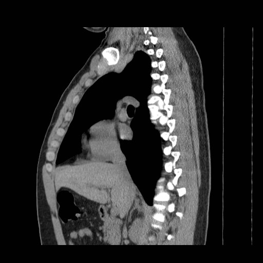 File:Aortic arch stent (Radiopaedia 30030-30595 B 1).jpg