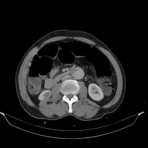 File:Aortic dissection- Stanford type A (Radiopaedia 22085-22085 Axial C+ delayed 26).jpg
