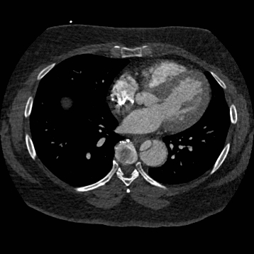 File:Aortic dissection (Radiopaedia 57969-64959 A 192).jpg