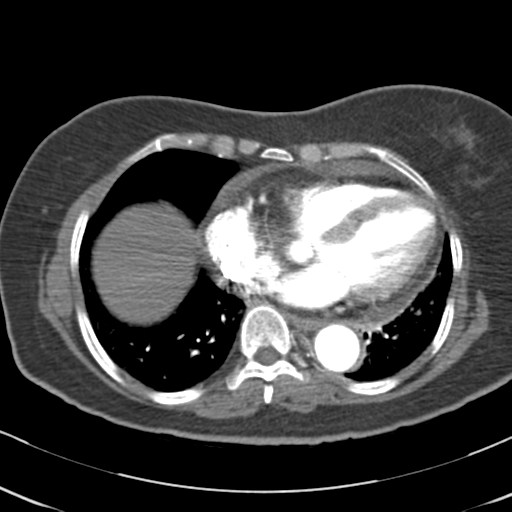 File:Aortic dissection - Stanford type A (Radiopaedia 39073-41259 A 53).png