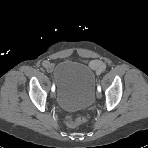Aortic intramural hematoma (Radiopaedia 31139-31838 B 153).jpg