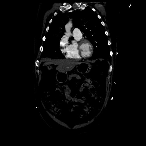 Aortic intramural hematoma (Radiopaedia 34260-35540 C 24).png