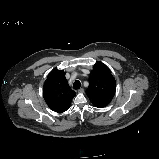 Aortic intramural hematoma (Radiopaedia 48463-53380 C 34).jpg