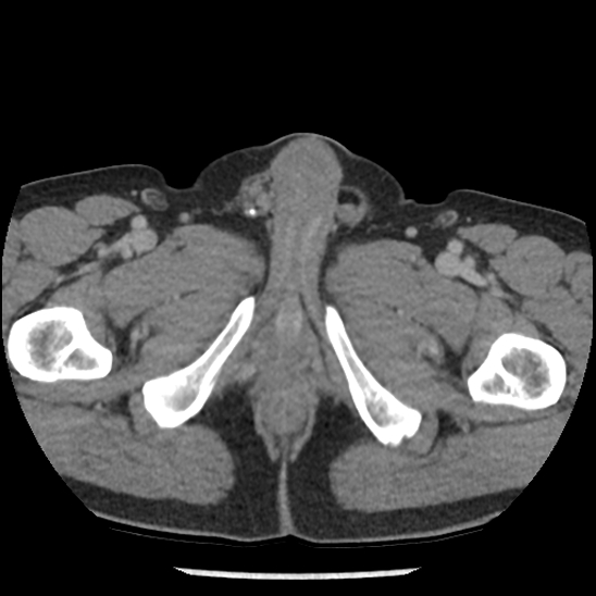 File:Aortic intramural hematoma (type B) (Radiopaedia 79323-92387 Axial C+ delayed 123).jpg