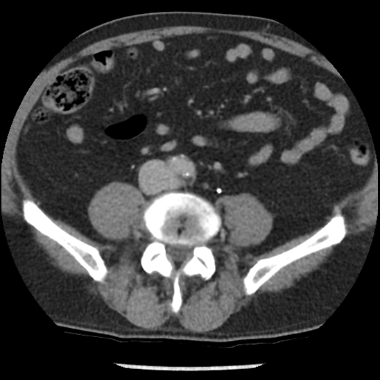 File:Aortic intramural hematoma (type B) (Radiopaedia 79323-92387 Axial C+ delayed 84).jpg