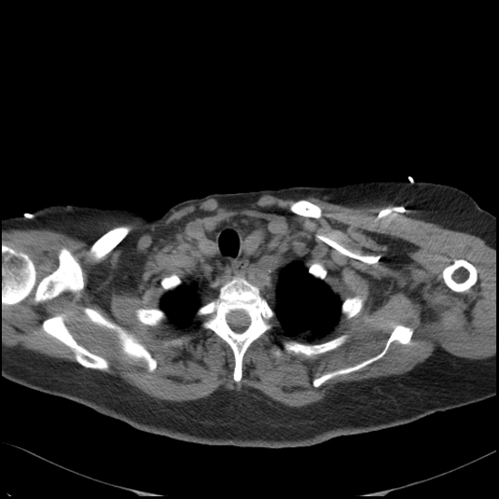 File:Aortic intramural hematoma with dissection and intramural blood pool (Radiopaedia 77373-89491 Axial non-contrast 15).jpg