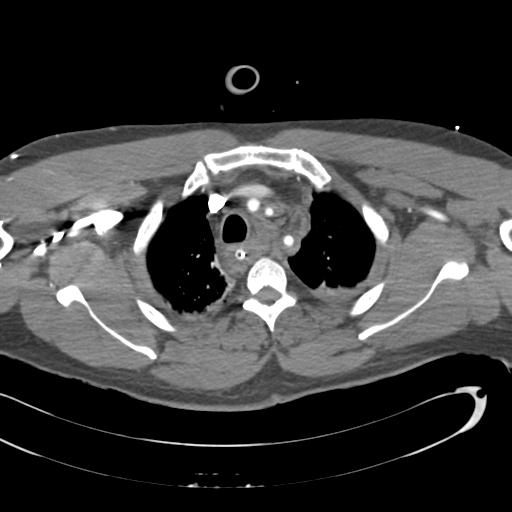 Aortic transection, diaphragmatic rupture and hemoperitoneum in a complex multitrauma patient (Radiopaedia 31701-32622 A 21).jpg
