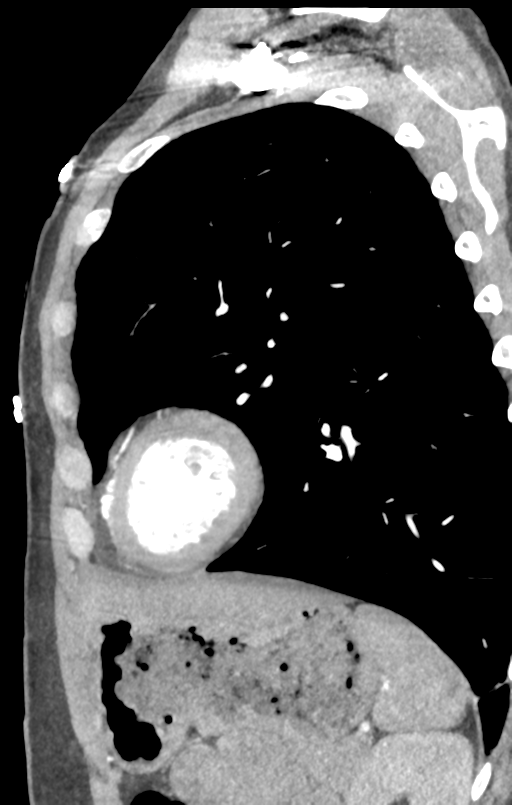 Aortic valve non-coronary cusp thrombus (Radiopaedia 55661-62189 C+ arterial phase 7).png