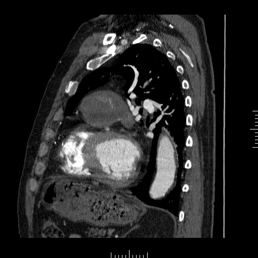 File:Aorto-coronary bypass graft aneurysms (Radiopaedia 40562-43157 C 28).png