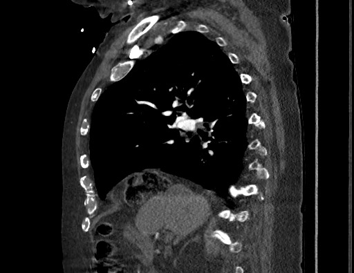 Aortoesophageal fistula with endovascular repair (Radiopaedia 73781-84592 Sagittal C+ CTPA 71).jpg