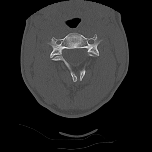 Apical pneumothorax on cervical spine CT (Radiopaedia 45343-49368 Axial bone window 31).jpg