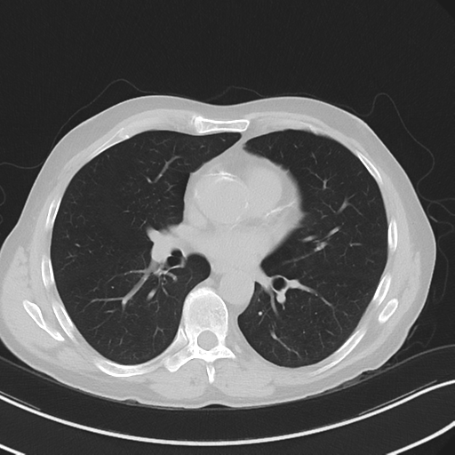 Apical pulmonary metastasis (Radiopaedia 46338-50754 Axial non-contrast 35).png