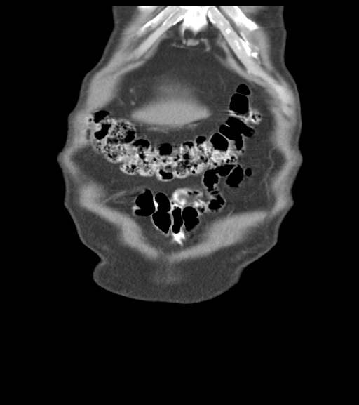 File:Appendiceal abscesses (Radiopaedia 50999-56542 Coronal non-contrast 11).png