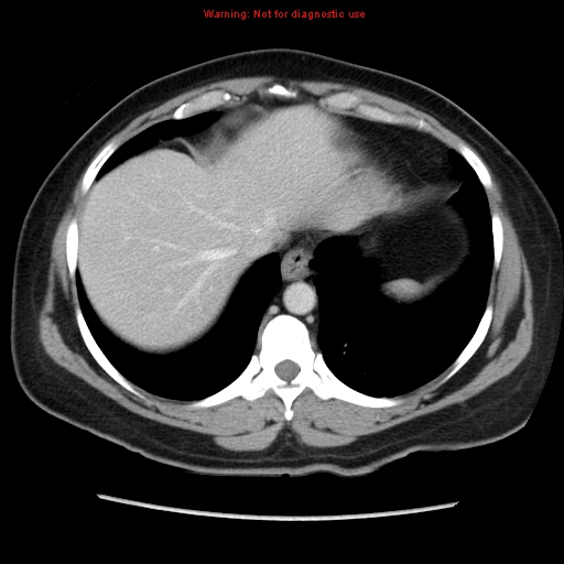 Appendiceal mucinous cystadenoma (Radiopaedia 8263-9111 Axial liver window 15).jpg