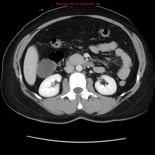 Appendiceal mucinous cystadenoma (Radiopaedia 8263-9111 Axial liver window 36).jpg
