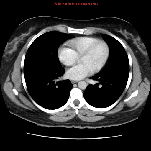 Appendiceal mucinous cystadenoma (Radiopaedia 8263-9111 Axial liver window 6).jpg