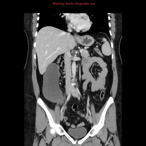 File:Appendiceal mucinous cystadenoma (Radiopaedia 8263-9111 B 37).jpg