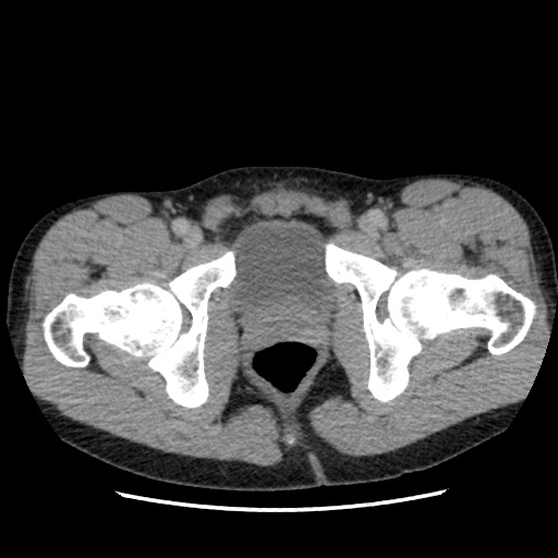 File:Appendicitis complicated by post-operative collection (Radiopaedia 35595-37113 A 78).jpg