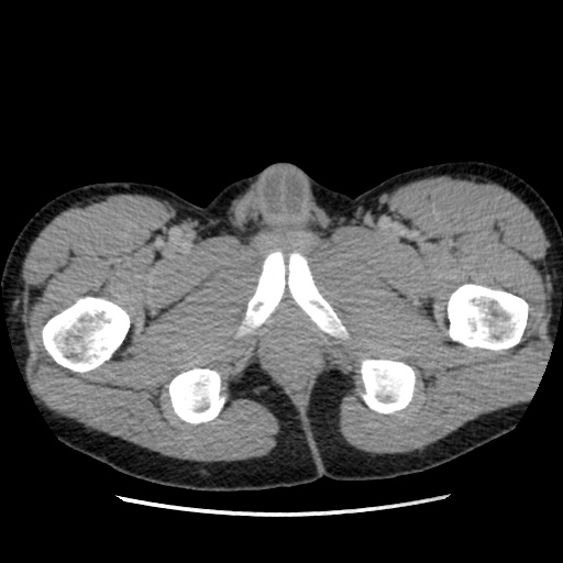 File:Appendicitis complicated by post-operative collection (Radiopaedia 35595-37113 A 85).jpg