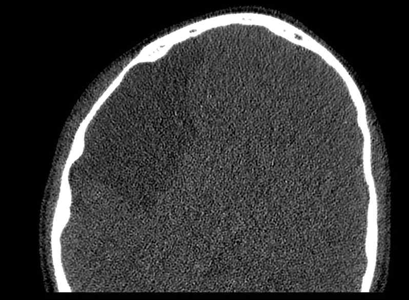 File:Arachnoid cyst- extremely large (Radiopaedia 68741-78450 Axial bone window 59).jpg