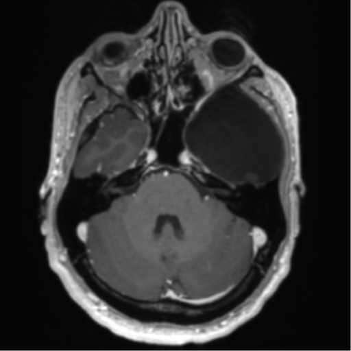 Arachnoid cyst with subdural hematoma (Radiopaedia 85892-101743 Axial T1 C+ 26).png