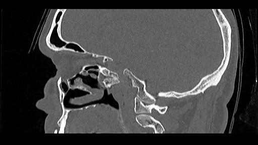 Arcuate foramen (Radiopaedia 89833-106944 Sagittal bone window 83).jpg