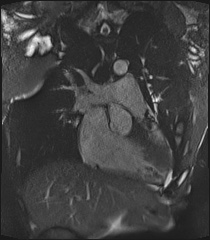Arrhythmogenic right ventricular cardiomyopathy (Radiopaedia 57972-64966 CINE R2 SSFP 5).jpg