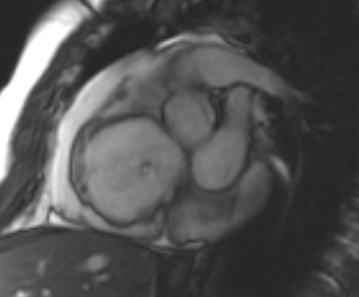 Arrhythmogenic right ventricular cardiomyopathy (Radiopaedia 69431-79307 Short axis cine 203).jpg