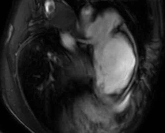 File:Arrhythmogenic right ventricular cardiomyopathy (Radiopaedia 69564-79464 4ch cine 126).jpg