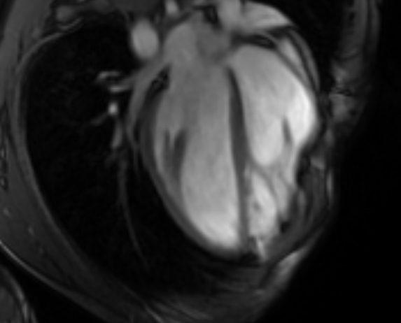 Arrhythmogenic right ventricular cardiomyopathy (Radiopaedia 69564-79464 4ch cine 58).jpg