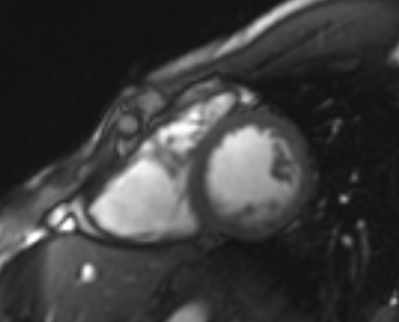 File:Arrhythmogenic right ventricular cardiomyopathy (Radiopaedia 69564-79464 short axis cine 103).jpg