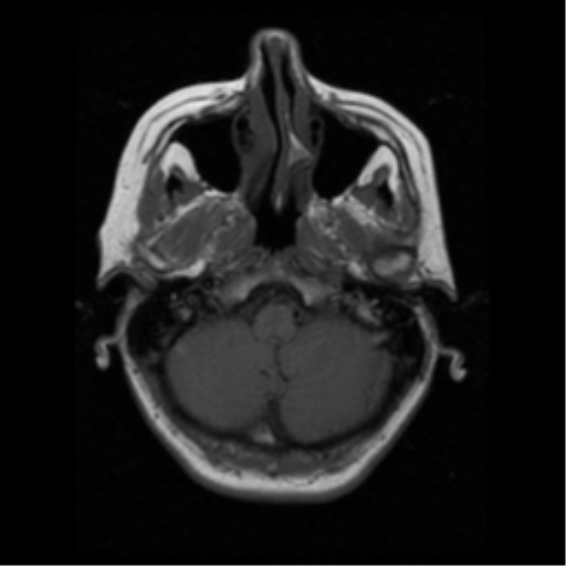 File:Arteriovenous malformation (cerebral) (Radiopaedia 40070-42580 Axial T1 3).png