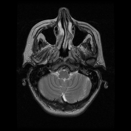 File:Arteriovenous malformation (cerebral) (Radiopaedia 40070-42580 Axial T2 5).png