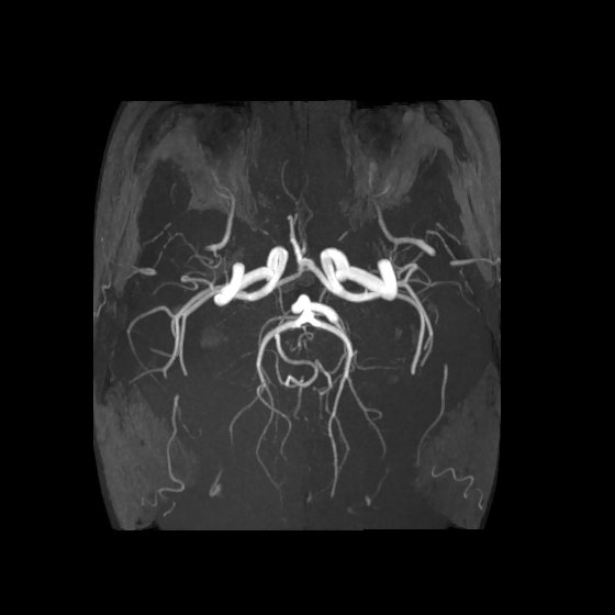 Artery of Percheron infarct (Radiopaedia 40966-43676 F 38).jpg