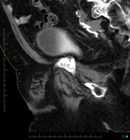 File:Artificial urethral sphincter (Radiopaedia 46937-51464 Sagittal C+ delayed 26).jpg