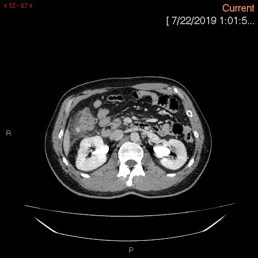 Ascending colonic diverticulum mimicking acute appendicitis (Radiopaedia 69943-80198 A 67).jpg