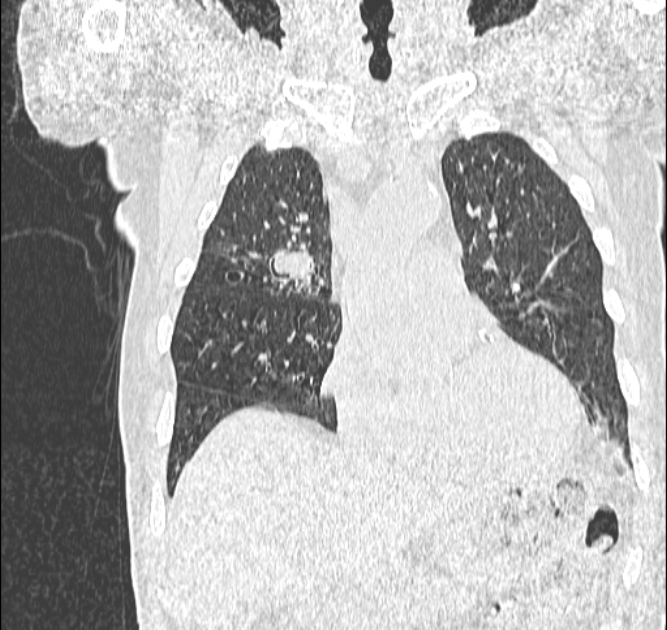 Aspergilloma (Radiopaedia 44592-48327 Coronal lung window 40).jpg