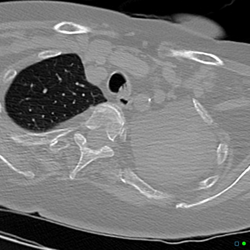 File:Aspirated food bolus obstruction of left main bronchus (Radiopaedia 29432-29904 Axial non-contrast 3).jpg