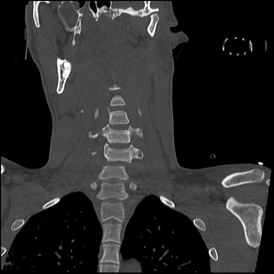 Atlanto-occipital dissociation (Traynelis type 1), C2 teardrop fracture, C6-7 facet joint dislocation (Radiopaedia 87655-104061 Coronal bone window 33).jpg