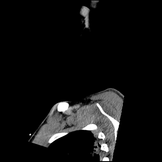 Atlanto-occipital dissociation (Traynelis type 1), C2 teardrop fracture, C6-7 facet joint dislocation (Radiopaedia 87655-104061 D 1).jpg