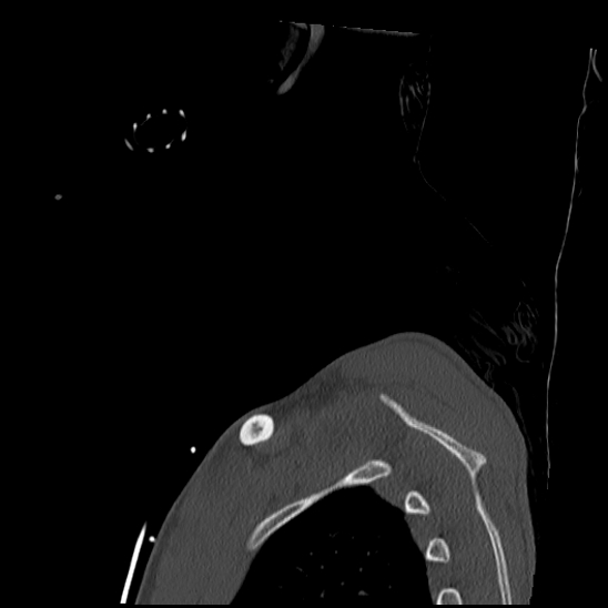 Atlanto-occipital dissociation (Traynelis type 1), C2 teardrop fracture, C6-7 facet joint dislocation (Radiopaedia 87655-104061 Sagittal bone window 77).jpg