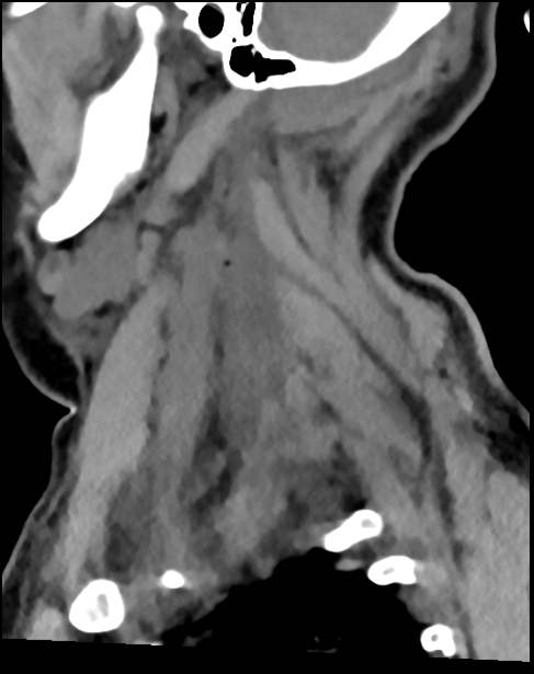 Atlanto-occipital dissociation - Traynelis type 1 (Radiopaedia 87570-103948 D 66).jpg