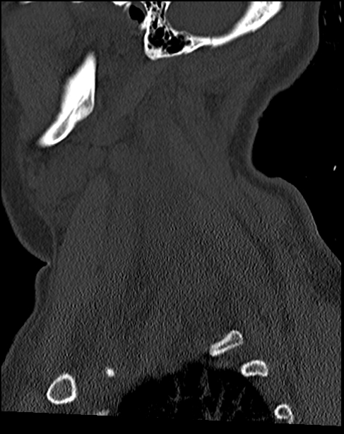 Atlanto-occipital dissociation - Traynelis type 1 (Radiopaedia 87570-103948 Sagittal bone window 67).jpg