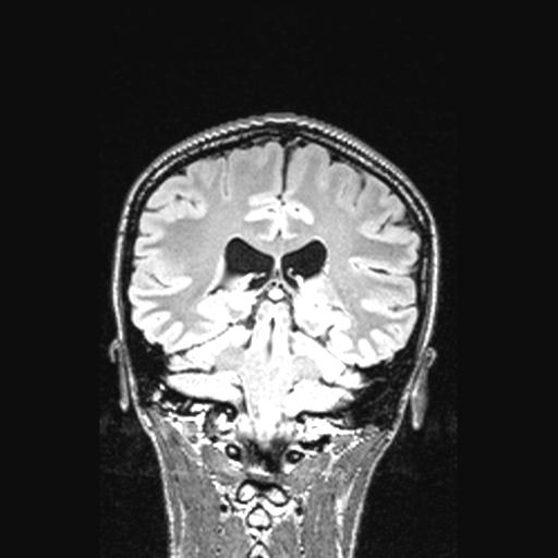 File:Atretic encephalocoele with inferior vermis hypoplasia (Radiopaedia 30443-31108 Coronal FLAIR 74).jpg