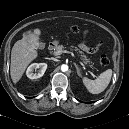 Atypical hepatocellular carcinoma (Radiopaedia 41744-44698 A 36).jpg
